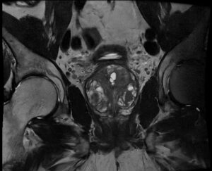 Prostate MRI Scan image